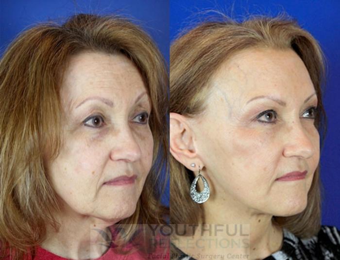Facelift / Reflection Lift Case 87 Before & After Right Oblique | Nashville, TN | Youthful Reflections