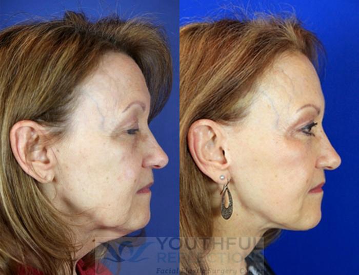 Facelift / Reflection Lift Case 87 Before & After Right Side | Nashville, TN | Youthful Reflections