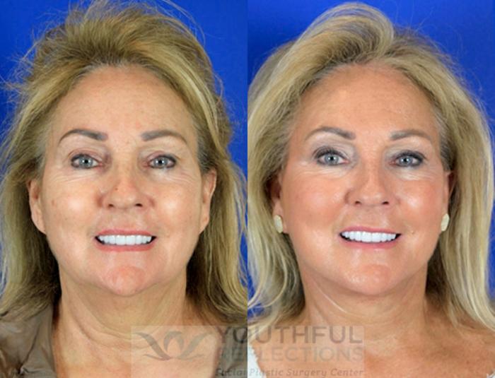 Facelift / Reflection Lift Case 88 Before & After Front | Nashville, TN | Youthful Reflections