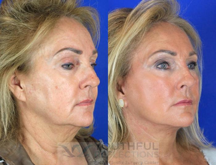 Facelift / Reflection Lift Case 88 Before & After Right Oblique | Nashville, TN | Youthful Reflections