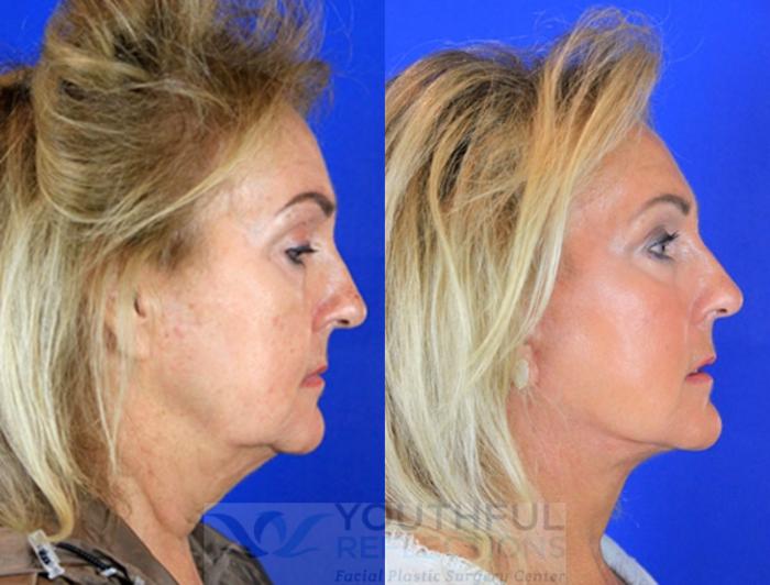 Facelift / Reflection Lift Case 88 Before & After Right Side | Nashville, TN | Youthful Reflections