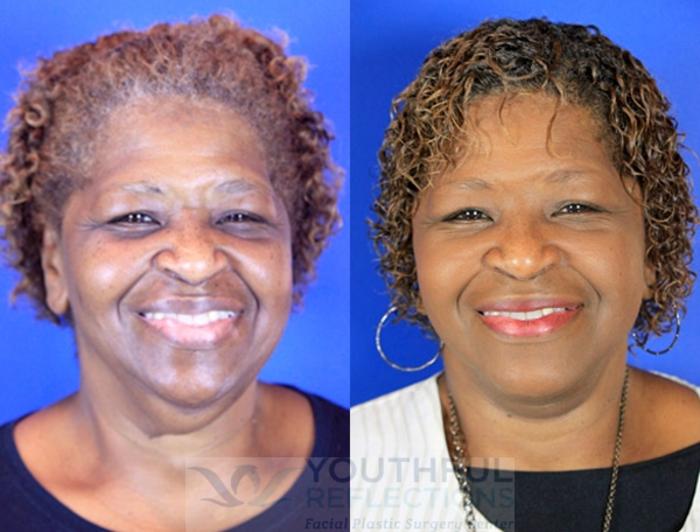 Facelift / Reflection Lift Case 89 Before & After Front | Nashville, TN | Youthful Reflections