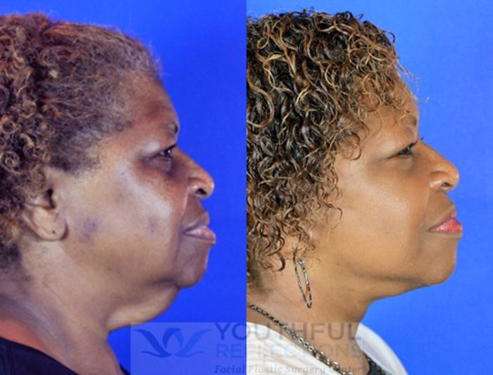 Facelift / Reflection Lift Case 89 Before & After Right Side | Nashville, TN | Youthful Reflections