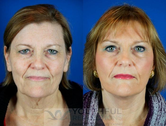 Facelift / Reflection Lift Case 9 Before & After Front | Nashville, TN | Youthful Reflections