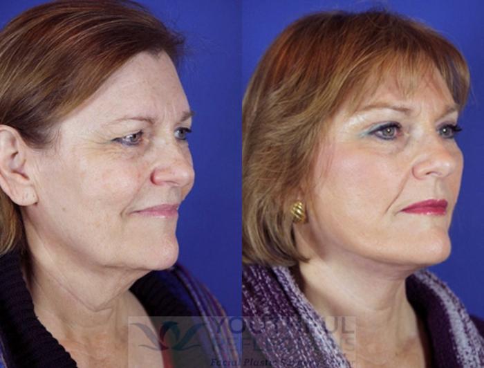 Facelift / Reflection Lift Case 9 Before & After Right Oblique | Nashville, TN | Youthful Reflections