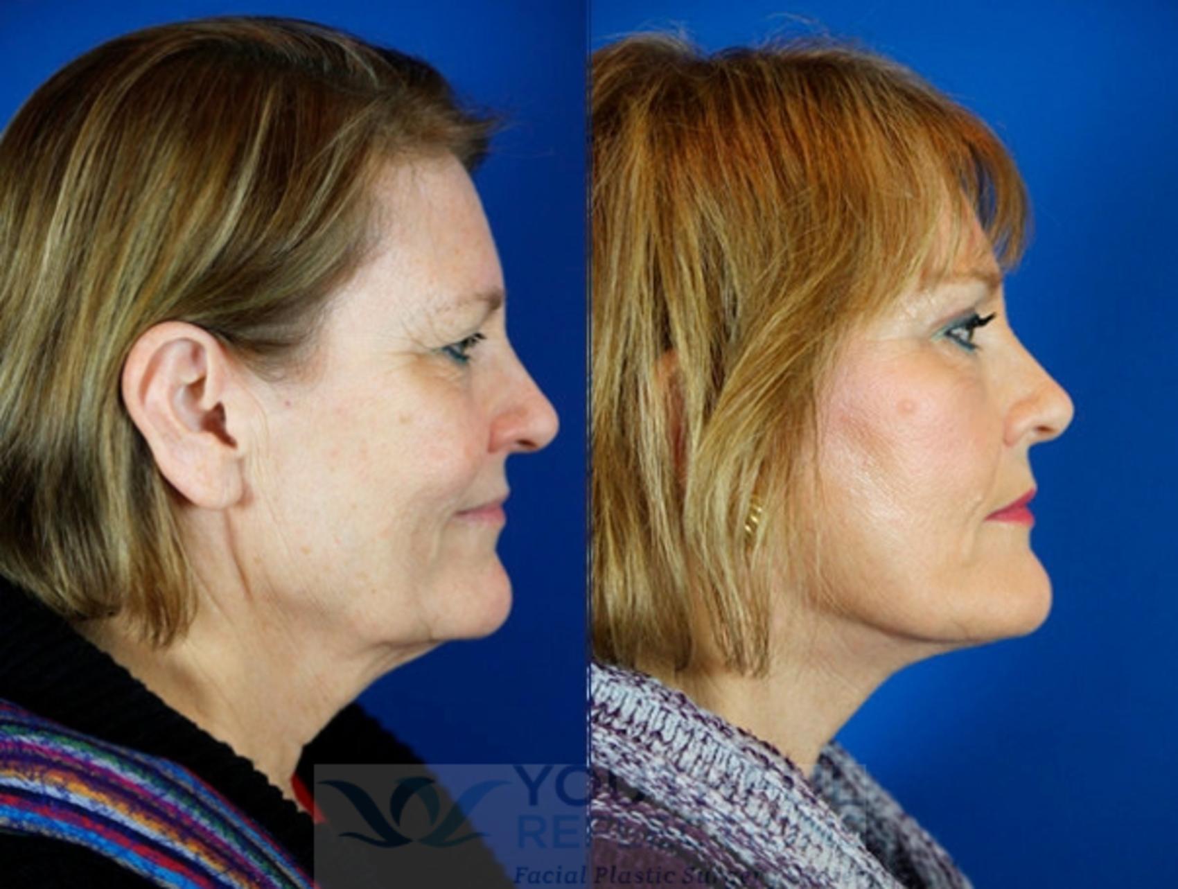 Facelift / Reflection Lift Case 9 Before & After Right Side | Nashville, TN | Youthful Reflections