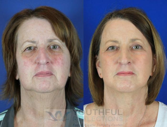 Facelift / Reflection Lift Case 90 Before & After Front | Nashville, TN | Youthful Reflections