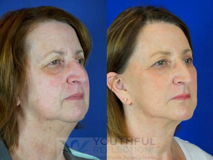Facelift / Reflection Lift Case 90 Before & After Right Oblique | Nashville, TN | Youthful Reflections