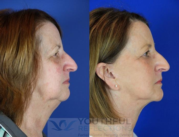 Facelift / Reflection Lift Case 90 Before & After Right Side | Nashville, TN | Youthful Reflections