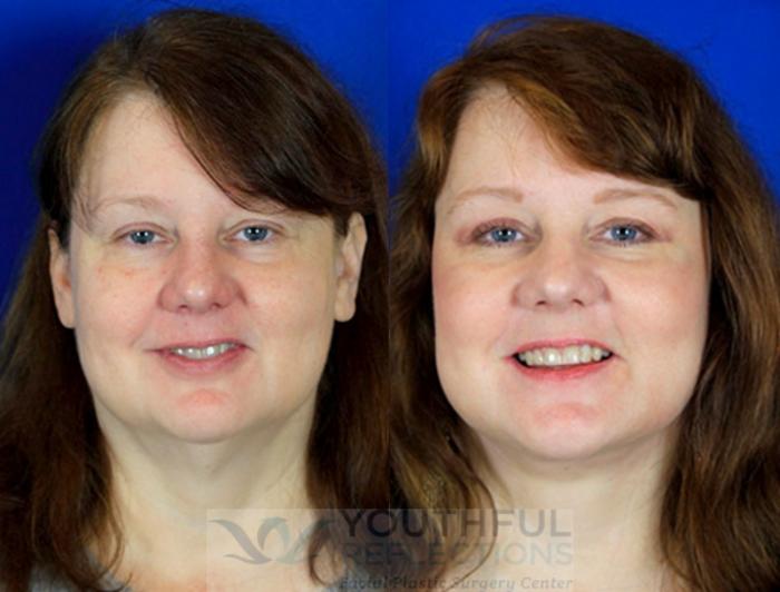 Facelift / Reflection Lift Case 91 Before & After Front | Nashville, TN | Youthful Reflections