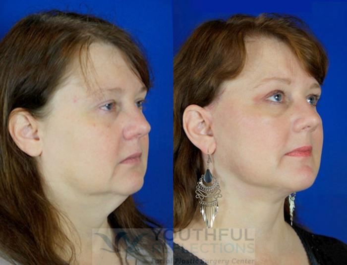 Facelift / Reflection Lift Case 91 Before & After Right Oblique | Nashville, TN | Youthful Reflections