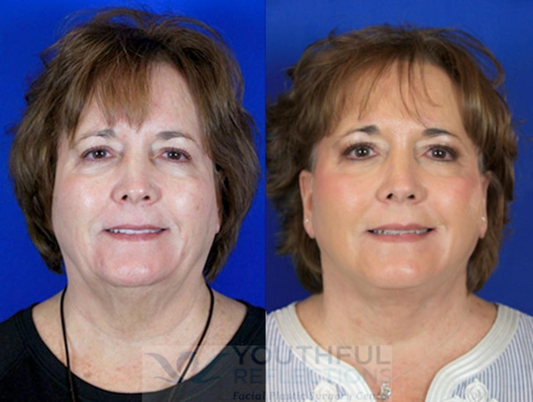 Facelift / Reflection Lift Case 92 Before & After Front | Nashville, TN | Youthful Reflections