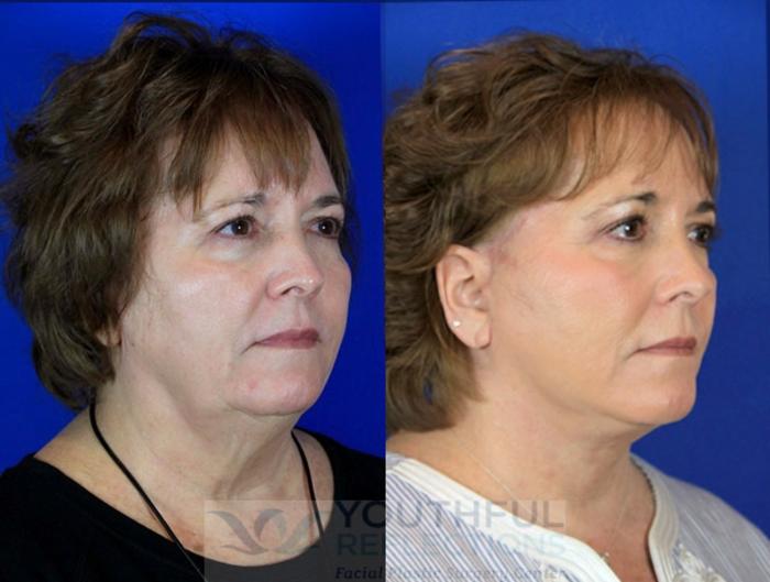 Facelift / Reflection Lift Case 92 Before & After Right Oblique | Nashville, TN | Youthful Reflections