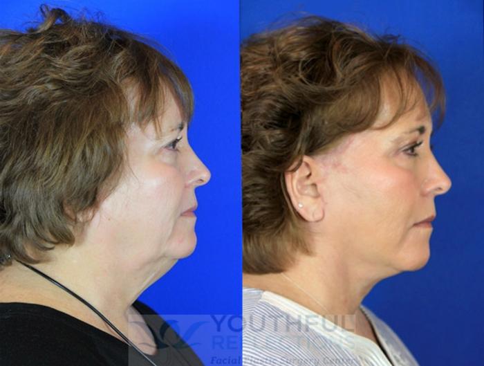 Facelift / Reflection Lift Case 92 Before & After Right Side | Nashville, TN | Youthful Reflections