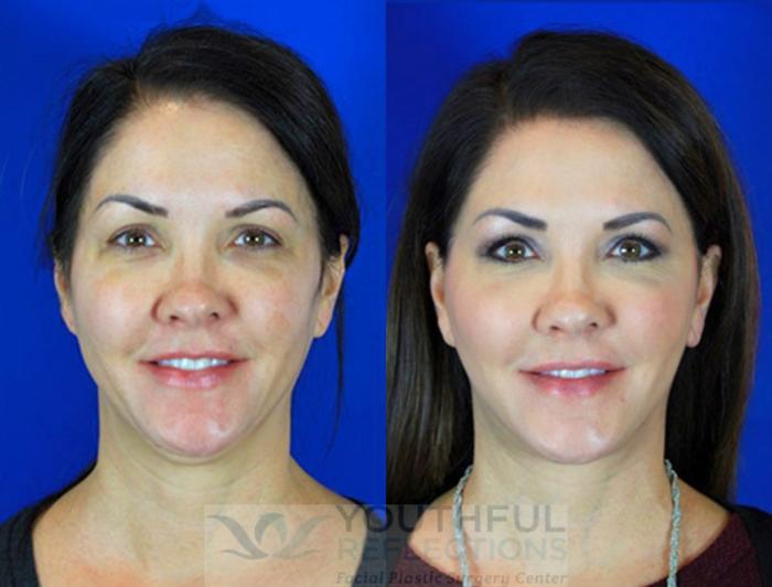 Facelift / Reflection Lift Case 93 Before & After Front | Nashville, TN | Youthful Reflections