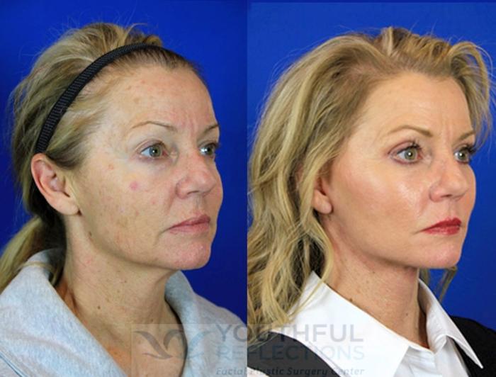 Facelift / Reflection Lift Case 95 Before & After Right Oblique | Nashville, TN | Youthful Reflections