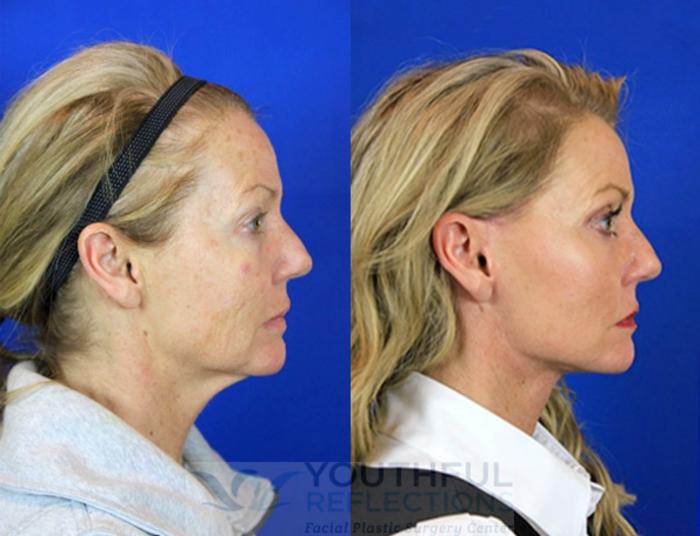Facelift / Reflection Lift Case 95 Before & After Right Side | Nashville, TN | Youthful Reflections
