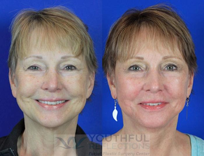Facelift / Reflection Lift Case 96 Before & After Front | Nashville, TN | Youthful Reflections