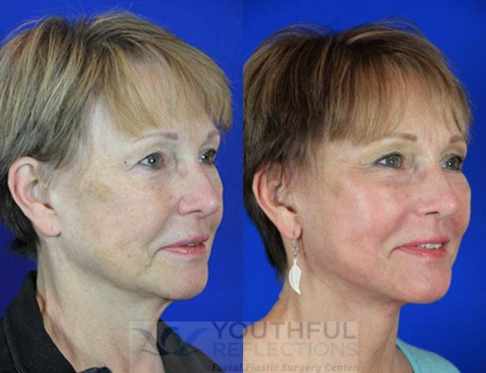 Facelift / Reflection Lift Case 96 Before & After Right Oblique | Nashville, TN | Youthful Reflections