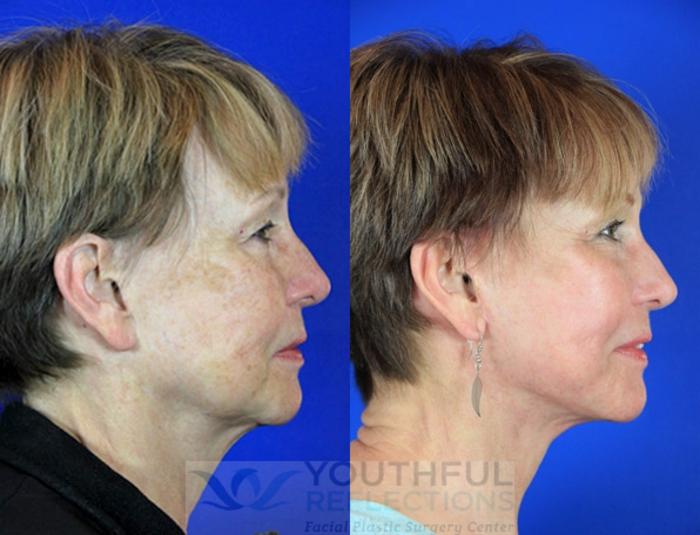 Facelift / Reflection Lift Case 96 Before & After Right Side | Nashville, TN | Youthful Reflections