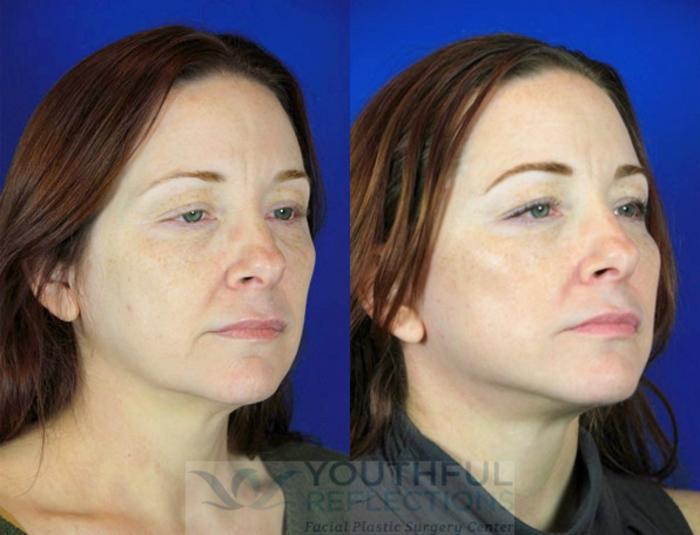 Facelift / Reflection Lift Case 97 Before & After Right Oblique | Nashville, TN | Youthful Reflections