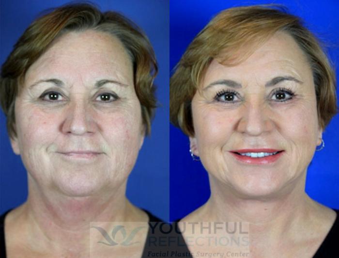 Facelift / Reflection Lift Case 98 Before & After Front | Nashville, TN | Youthful Reflections