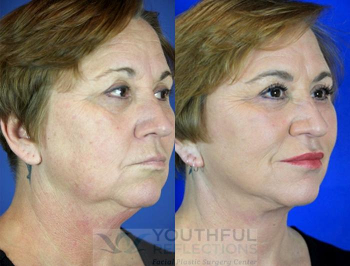 Facelift / Reflection Lift Case 98 Before & After Right Oblique | Nashville, TN | Youthful Reflections