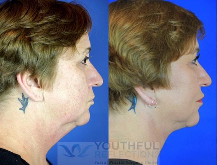 Facelift / Reflection Lift Case 98 Before & After Right Side | Nashville, TN | Youthful Reflections