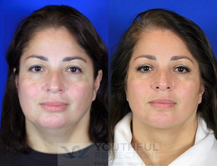 Neck Liposuction Case 94 Before & After Front | Nashville, TN | Youthful Reflections