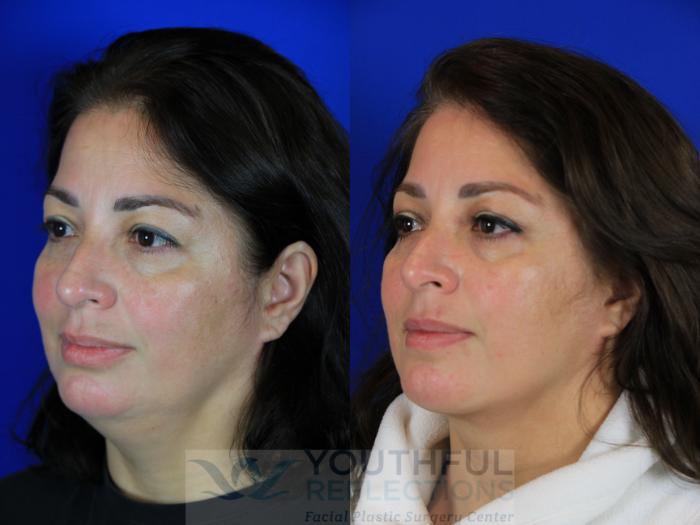 Neck Liposuction Case 94 Before & After Left Oblique | Nashville, TN | Youthful Reflections