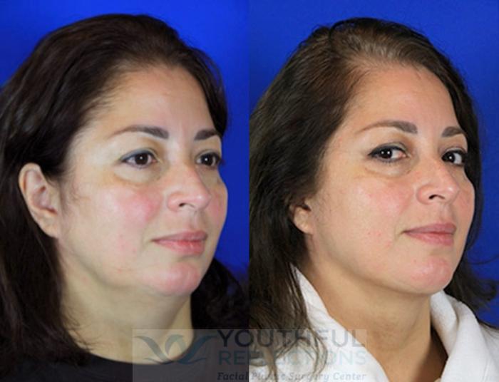 Neck Liposuction Case 94 Before & After Right Oblique | Nashville, TN | Youthful Reflections