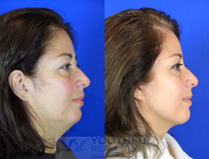 Neck Liposuction Case 94 Before & After Right Side | Nashville, TN | Youthful Reflections